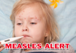 Measles Alert