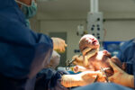 Caesarian