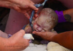 breech-birth