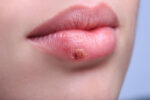 Let that tell tale tingle and burning sensation be your warning of a cold sore coming on.