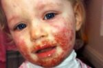 Young girl with herpes virus on her face from cold sore