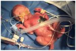 Little miracle baby Austin Buttle