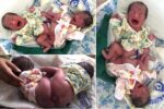Surprised Mum Naturally Delivers Conjoined Twins