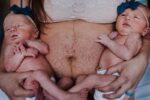 stretch marks after twins