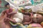 most premature baby ever born at 21 weeks