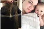 postpartum hair loss