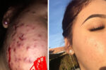 young woman shares natural acne treatment