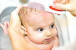 how to get rid of cradle cap