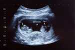 pregnant twins 67 year old woman