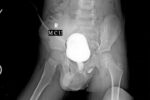 pen in boy's penis xray