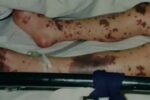 meningococcal rash on child's leg