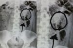 IUD in kidney