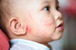 Baby with eczema, rash or allergy on face