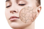 Woman with dry winter skin | dermal Therapy