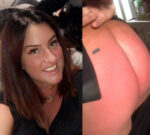 Danielle Cairn sunburnt bum