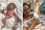 Premature birth story - Rachel and Miles