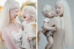 albino sisters born with albinism
