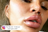 Chrissy Teigen lips