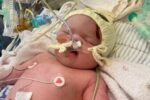 baby skull fracture - forceps delivery