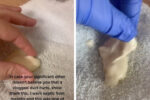 clogged milk duct