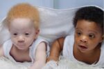 twin boys albinism
