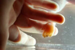 saline bath miscarriage