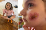 HSV infection - Aubree
