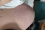pupp rash