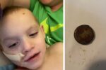 swallowed button battery