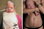 Ethan's groundbreaking surgery while in the womb