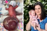 Saylor's story - tumour double she size