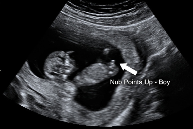 4 Ways to Determine the Gender on Ultrasound Scans - Is it a Boy or Girl?