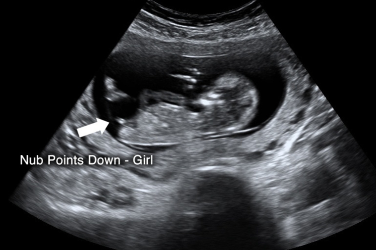 4 Ways to Determine the Gender on Ultrasound Scans - Is it a Boy or Girl?