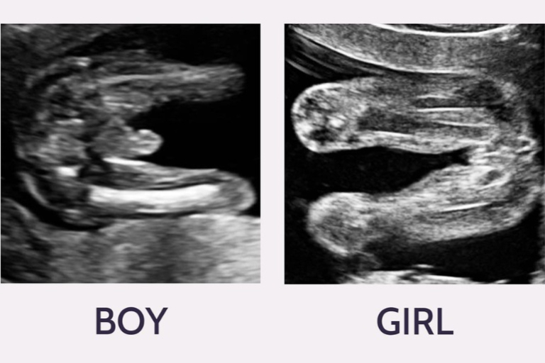 4 Ways to Determine the Gender on Ultrasound Scans - Is it a Boy or Girl?