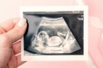 gender on ultrasound