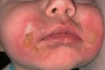 celery causes margarita burns in infant