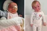 Sturge-Weber syndrome. Lily's story