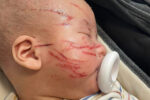 newborn scratched during childcare injury