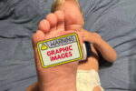 toddler 2nd degree burns on feet due to hot pavement
