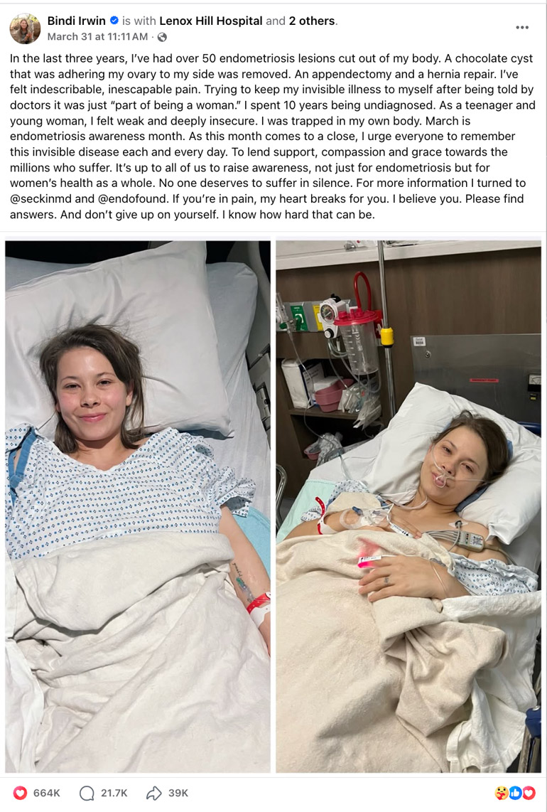 Bindi. Irwin Endometriosis Battle