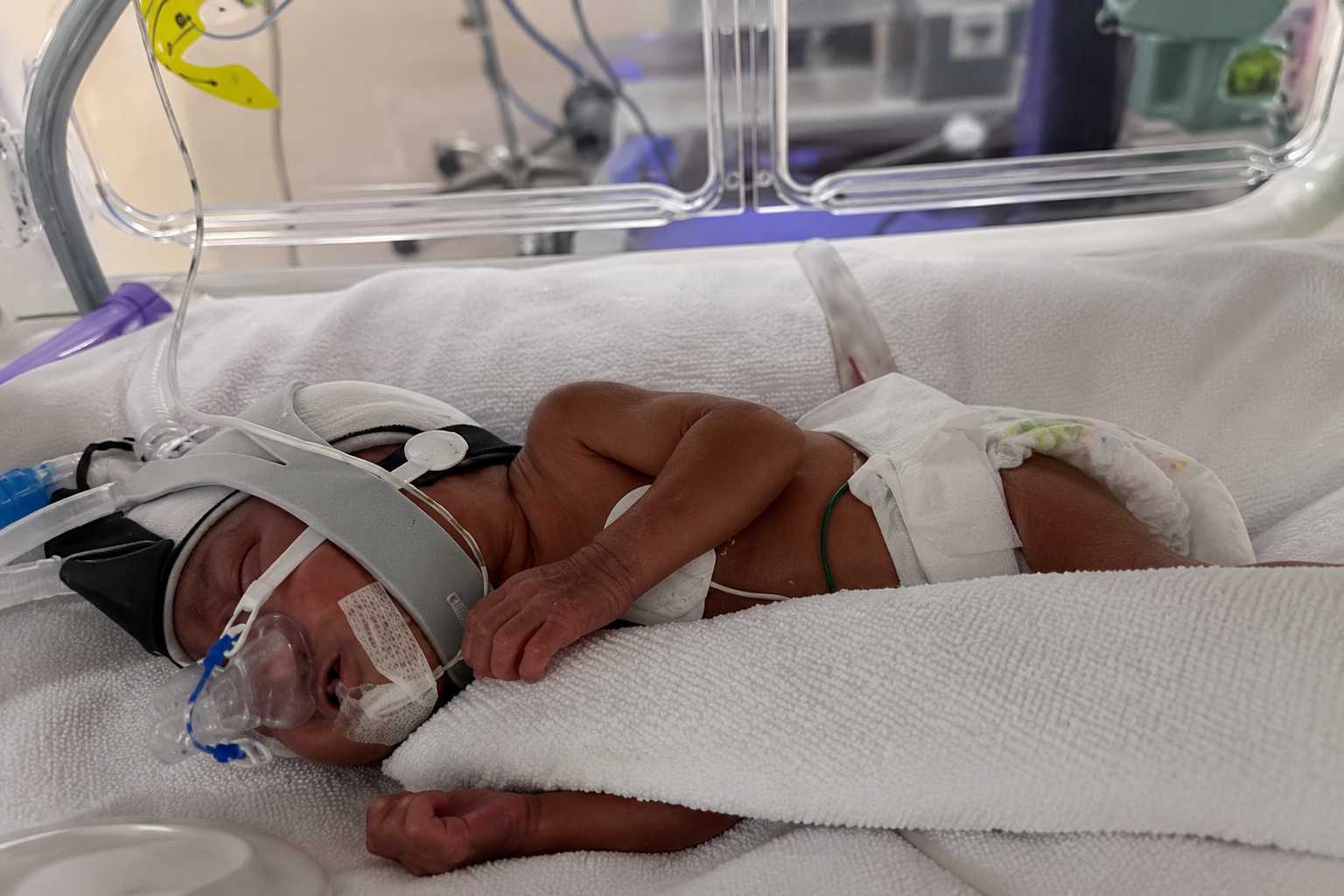 Australia’s Youngest Premature Baby